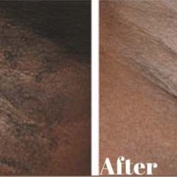 Natural Radiance Spa - Laser hair removal