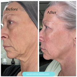 Curative Skin Therapies - Before and after Jet Plasma.