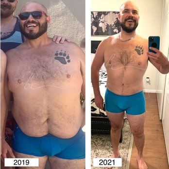 Dr. Carmina Cardenas - After Weight Loss Patient - Lower Body Lift - Cosmetic Surgeons Near Me - Tijuana, BCN Dr. Carmina Cardenas - After Weight Loss Patient - Lower Body Lift - Cosmetic Surgeons Near Me - Tijuana, BCN