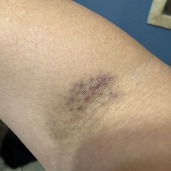 Quest Diagnostics - My arm 2 days after getting bloodwork donee - Laboratory Testing Near Me - Long Beach, California Quest Diagnostics - My arm 2 days after getting bloodwork donee - Laboratory Testing Near Me - Long Beach, California