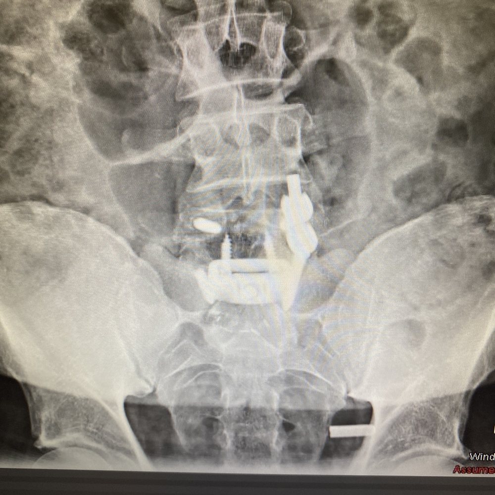 Barrow Brain and Spine - Deer Valley - L5S1 fusion - Neurologist Near Me - Phoenix, Arizona