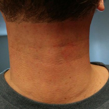 The Barber's Pole - Razor burn from the front - Barbers Near Me - Vancouver, Washington