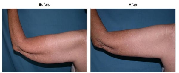 Photo of Suzanne Quardt MD - Palm Desert Plastic Surgery - Rancho Mirage, CA, US. Plastic Surgery Before & After Pictures https://palmdesertplasticsurgery.com/photo-gallery/