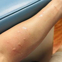 Offenberger Jacob, MD - Allergy & Asthma Relief Experts - Allergy prick skin test results fast within 20 minutes. No pain or marks left behind. Test for indoor outdoor environment and food