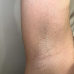 EBG Laser Hair Removal Studio - After only a few sessions of laser hair removal of the under arms.