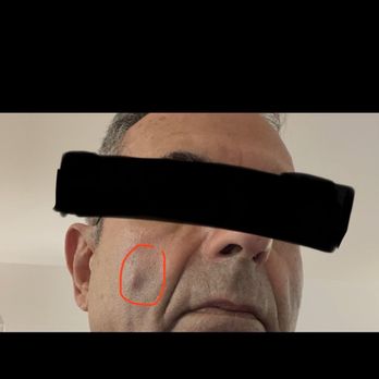 Afrasiabi Shirin, MD - The initial visit and the bump doesn't even look like your average "pimple" it's bigger and he had complains regarding this matter. - Internal Medicine Near Me - Irvine, California Afrasiabi Shirin, MD - The initial visit and the bump doesn't even look like your average "pimple" it's bigger and he had complains regarding this matter. - Internal Medicine Near Me - Irvine, California