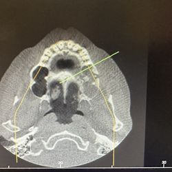 Guyette Facial & Oral Surgery Center - The scan evidencing a problem in the left sinus area after Dr.Smutko's procedure.