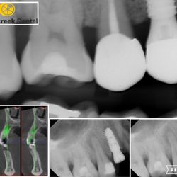 Lemoncreek Dental - Immediate dental implant placement- 3D treatment planned. Perfect execution.