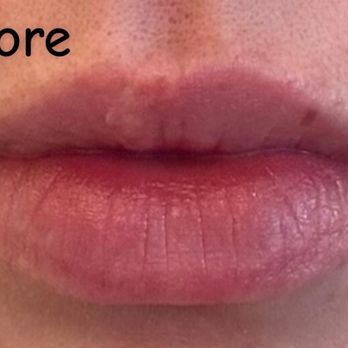 Beauty Lab + Laser Med Spa | Murray - Before any treatment - Medical Spas Near Me - Murray, Utah