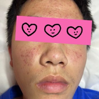 Serenity Beauty Facial - Before treatment # 3 - Skin Care Near Me - Arcadia, California