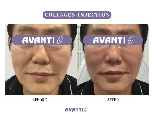 Collagen Injection - Looking to restore youthful volume and enhance your facial contours? Our collagen injection treatment is expertly crafted to target aging areas like the cheeks, temples, nasolabial folds, forehead, and under-eye region. By combining hyaluronic acid with PDLLA, this treatment provides immediate volumization with long-lasting results through continuous collagen stimulation. Collagen Injection - Looking to restore youthful volume and enhance your facial contours? Our collagen injection treatment is expertly crafted to target aging areas like the cheeks, temples, nasolabial folds, forehead, and under-eye region. By combining hyaluronic acid with PDLLA, this treatment provides immediate volumization with long-lasting results through continuous collagen stimulation.
