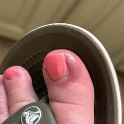 Le's Nails Hi - My swollen infected toe