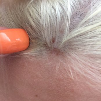 Nikos Hair Studio - she burned her scalp with how long the bleach was on for. - Hair Salons Near Me - Roselle, Illinois Nikos Hair Studio - she burned her scalp with how long the bleach was on for. - Hair Salons Near Me - Roselle, Illinois