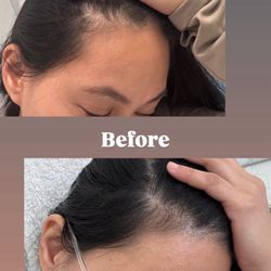 Pure Health - PRP injection results after 2 sessions