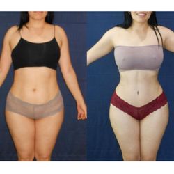 Clínica Renueva - Extended Tummy tuck plus bbl with muscle repair