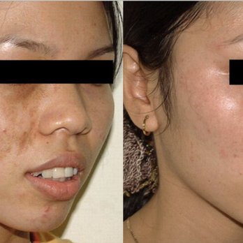 Ageless Beauty Laser and Spa - BEFORE & AFTER - Acne Treatment Near Me - Surrey, British Columbia Ageless Beauty Laser and Spa - BEFORE & AFTER - Acne Treatment Near Me - Surrey, British Columbia