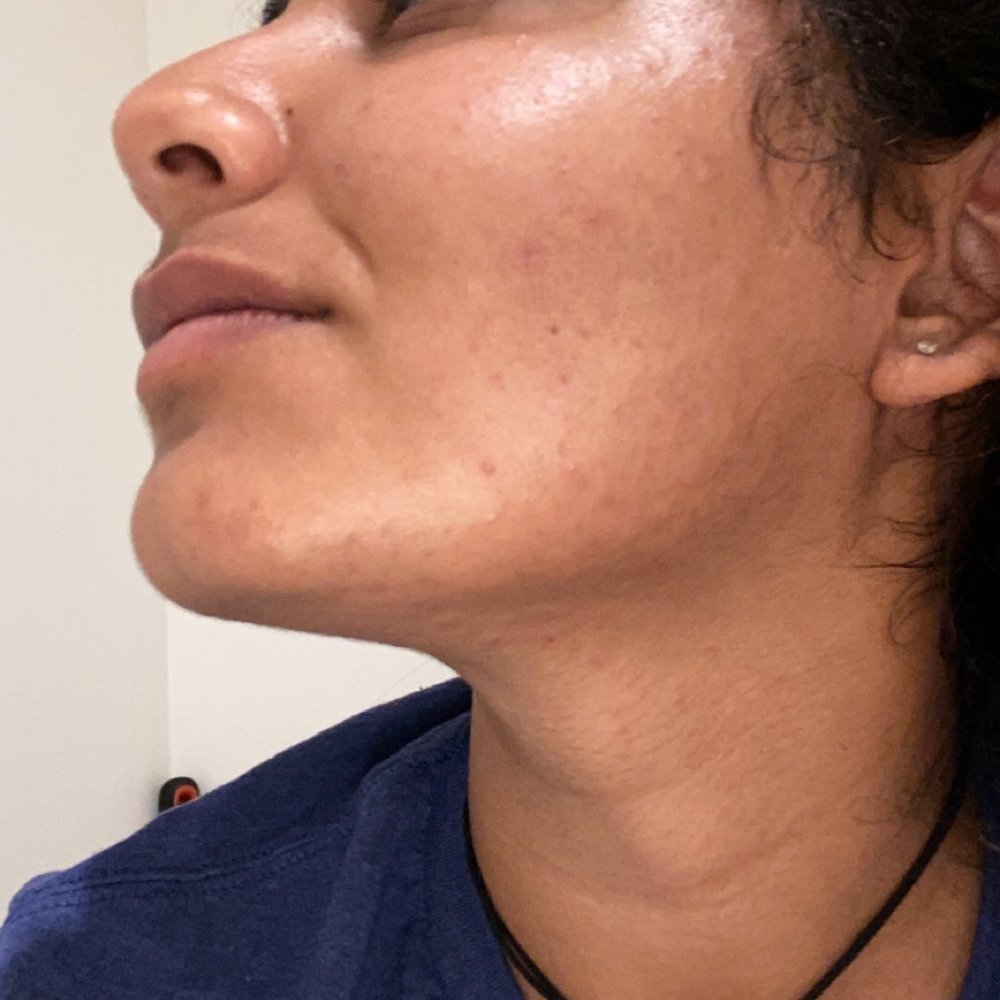 Bare Electrolysis - Clear smooth hairless - Hair Removal Near Me - San Diego, California