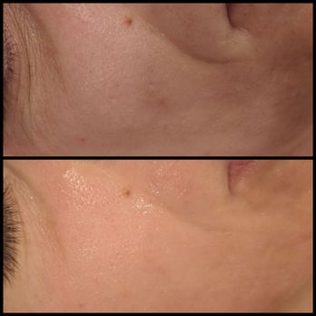 newGLO - One treatment Microchanneling - Skin Care Near Me - Brentwood, California