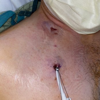 Ho Ho Chinese Food - Dialysis catheter after contracting salmonella and it infecting my blood stream - Chinese Near Me - Riverside, California Ho Ho Chinese Food - Dialysis catheter after contracting salmonella and it infecting my blood stream - Chinese Near Me - Riverside, California