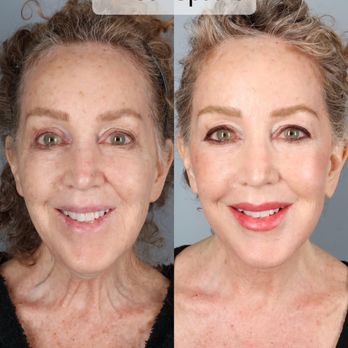 Omar Hussain, MD - Mini Facelift results at 4 weeks - Plastic Surgeons Near Me - Beverly Hills, California Omar Hussain, MD - Mini Facelift results at 4 weeks - Plastic Surgeons Near Me - Beverly Hills, California