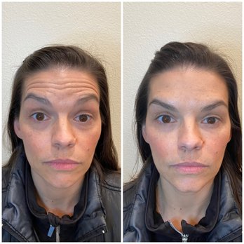 Beautiful Med Spa - treating forehead lines - Medical Spas Near Me - Las Vegas, Nevada Beautiful Med Spa - treating forehead lines - Medical Spas Near Me - Las Vegas, Nevada