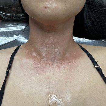 Laser Cliniqúe | San Diego's Premier Medical Spa - This was my neck right after the treatment at 9am Morpheus8 - Laser Hair Removal Near Me - San Diego, California