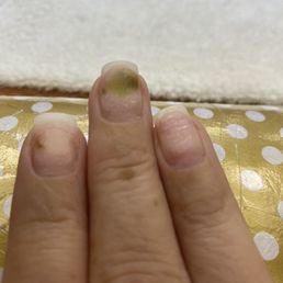 Nail Fungus Nail Fungus
