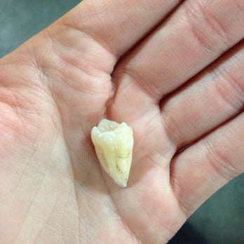 Meir Agaki, DDS - My wisdom tooth that was removed. - Cosmetic Dentists Near Me - Los Angeles, California Meir Agaki, DDS - My wisdom tooth that was removed. - Cosmetic Dentists Near Me - Los Angeles, California