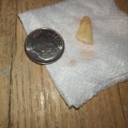 Coastal Smiles Family Dentistry - What was left in my socket after removal.