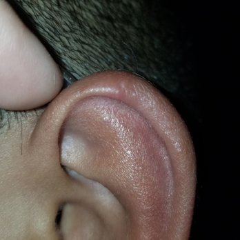 Sunset Marina Resort - The one on his ear, with puss.  Yes we used bug repellant and still got bit. - Resorts Near Me - Cancún, ROO