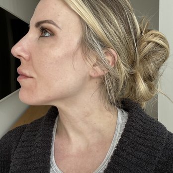 Prime MD Aesthetics + Wellness - 6-hours post-PDO thread procedure (tip is lifted and the bridge is smoother/more defined) - done by Angie - Medical Centers Near Me - Raleigh, North Carolina
