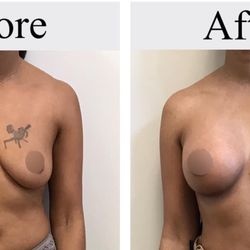 Orland Park Plastic Surgery - Before and After
Procedure: Breast Augmentation with Silicone Implants