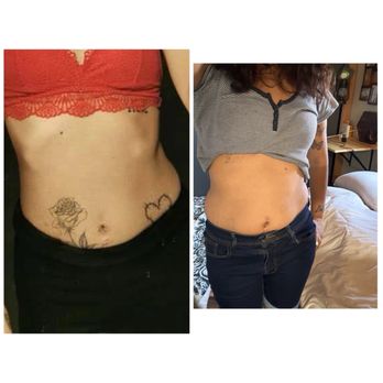 Zapatat - Before & after - Tattoo Removal Near Me - Arlington, Virginia