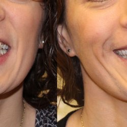 Blue Mountain Dental Care - Smile makeover at our clinic