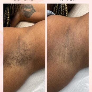 Laser N Beyond - New Hyde Park - Laser Hair Removal Near Me - New Hyde Park, New York Laser N Beyond - New Hyde Park - Laser Hair Removal Near Me - New Hyde Park, New York