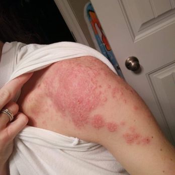 SGMC Health - We went for a Staph Infection flare and got told it's nothing but eczema. - Urologists Near Me - Valdosta, Georgia