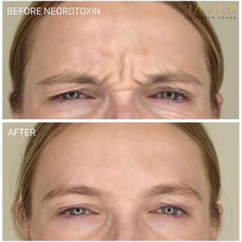 Javan Wellness - Botox, Xeomin, and Dysport - Medical Spas Near Me - Washington, DC, District of Columbia