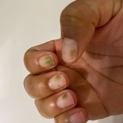 Fine Touch Nails - Nail fungus acquired after several applications of powdered acrylic