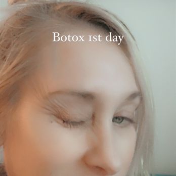 Alchemy 43 - West 3rd - Eye area of Botox 1 st day - Skin Care Near Me - Los Angeles, California