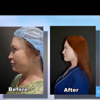Smith Plastic Surgery - This is a before and after photo of one of my procedures done by Dr. Smith. - Cosmetic Surgeons Near Me - Las Vegas, Nevada