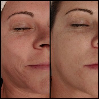 newGLO - Before and After. 3 treatments - Skin Care Near Me - Brentwood, California newGLO - Before and After. 3 treatments - Skin Care Near Me - Brentwood, California