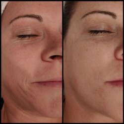 newGLO - Before and After. 3 treatments