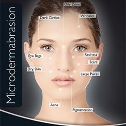 Apollo Beauty Salon - Benefits of Microdermabrasion