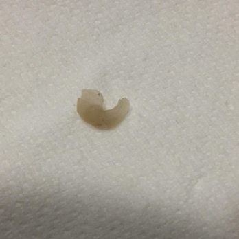 Pleasant Street Dental - The filling - Cosmetic Dentists Near Me - Worcester, Massachusetts