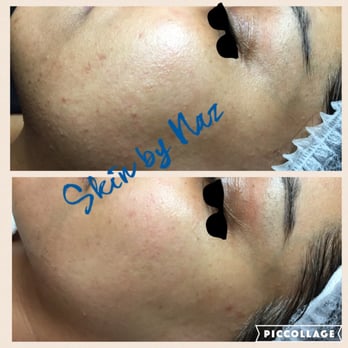 Skin By Naz - Uneven skin texture and acne scars were cleared in 3-4 treatments and recommended homecare - Day Spas Near Me - Colleyville, Texas Skin By Naz - Uneven skin texture and acne scars were cleared in 3-4 treatments and recommended homecare - Day Spas Near Me - Colleyville, Texas