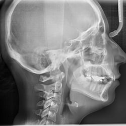 Lateral Cephalometric X-ray