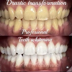 Rubi Montejano - An awesome transformation by using Khor teeth whitening!