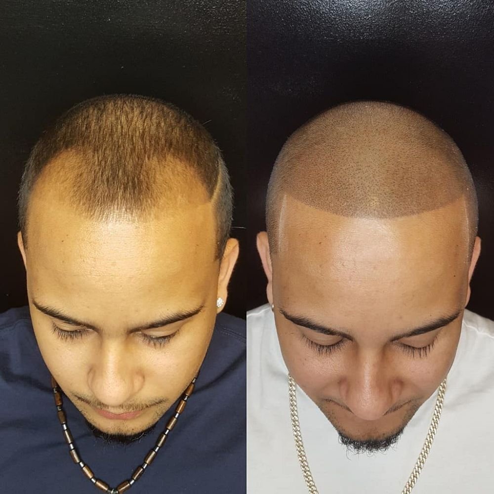 SCALP AND BROWS NJ 290 Union Blvd, Totowa, New Jersey Hair Loss