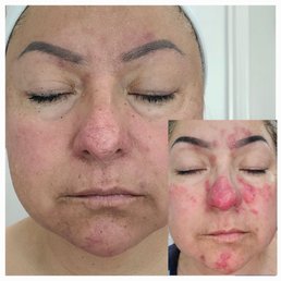 The bottom "before" picture was taken about a week into her helping me. It was so much worse. Thank God for Su Sachar. The bottom "before" picture was taken about a week into her helping me. It was so much worse. Thank God for Su Sachar.