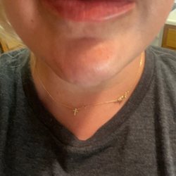 Central Coast Medical Aesthetics - Lip filler one appointment:)